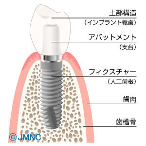 インプラント　画像.jpg